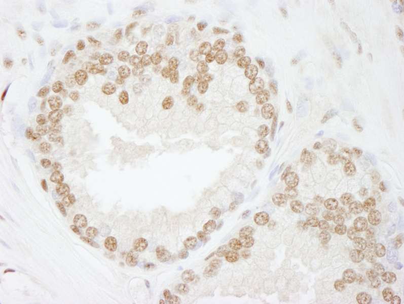 Detection of Human SMARCC2/BAF170 by Immunohistochemistry. Sample: FFPE section of human prostate adenocarcinoma. Antibody: Affinity purified rabbit anti-SMARCC2/BAF170 used at a dilution of 1:500.