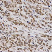Immunohistochemistry of paraffin-embedded human stomach cancer using SMARCE1 antibody at dilution of 1:200 (x400 lens)