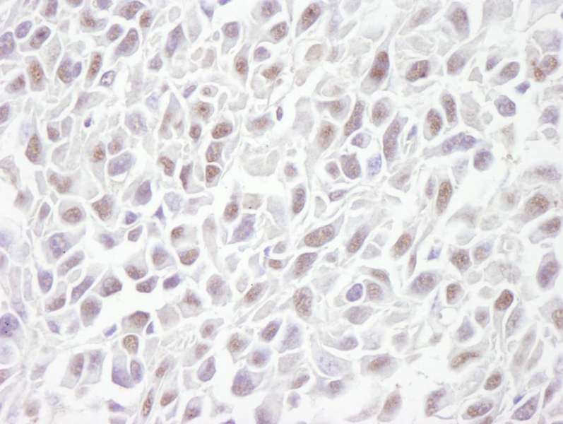 Detection of Mouse SMC3 by Immunohistochemistry. Sample: FFPE section of mouse squamous cell carcinoma. Antibody: Affinity purified rabbit anti-SMC3 used at a dilution of 1:250. Detection: DAB.