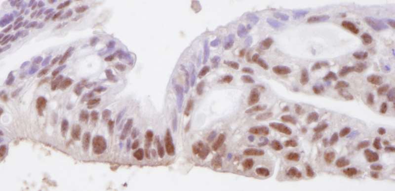 Detection of Human SMC3 by Immunohistochemistry. Sample: FFPE section of human ovarian carcinoma Antibody: Affinity purified rabbit anti-SMC3 used at a dilution of 1:250. Detection: DAB.