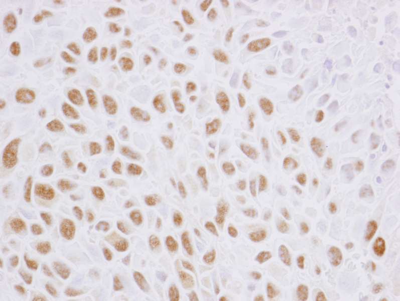 Detection of Mouse Phospho-SMC3 (S1083) by Immunohistochemistry. Sample: FFPE section of mouse squamous cell carcinoma. Antibody: Affinity purified rabbit anti-phospho SMC3 (S1083) used at a dilution of 1:2,500 (0.4 ug/ml). Detection: DAB.