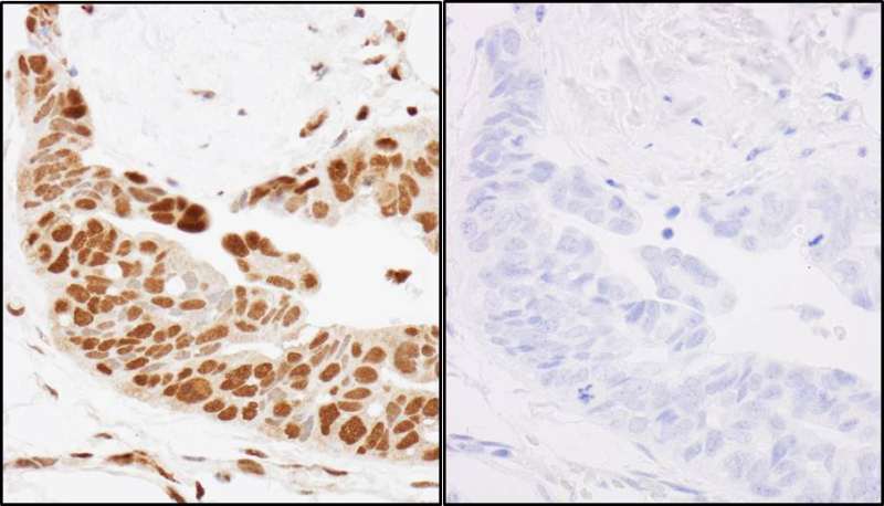 Detection of Human Phospho-SMC3 (S1083) by Immunohistochemistry. Samples: FFPE serial sections of human ovarian carcinoma. Mock phosphatase treated section (left) and calf intestinal phosphatase-treated section (right). Antibody: Affinity purified rabbit anti-Phospho-SMC3 (S1083) used at a dilution of 1:2,500 (0.4 ug/ml). Detection: DAB.