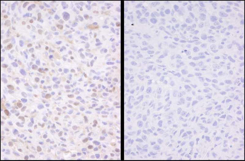 Detection of Mouse Phospho-SMC3 (S1083) by Immunohistochemistry. Samples: FFPE serial sections of mouse squamous cell carcinoma. Mock phosphatase treated section (left) or calf intestinal phosphatase-treated section (right) immunostained for Phospho-SMC3. Antibody: Affinity purified rabbit anti-Phospho-SMC3 (S1083) used at a dilution of 1:250. Detection: DAB staining using anti-rabbit IHC Antibody at a dilution of 1:100.