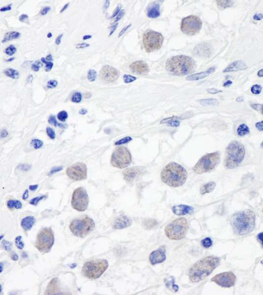 Detection of Human SMC3 by Immunohistochemistry. Sample: FFPE section of human testicular seminoma. Antibody: Affinity purified rabbit anti-SMC3 used at a dilution of 1:1000 (1 ug/ml). Detection: DAB.