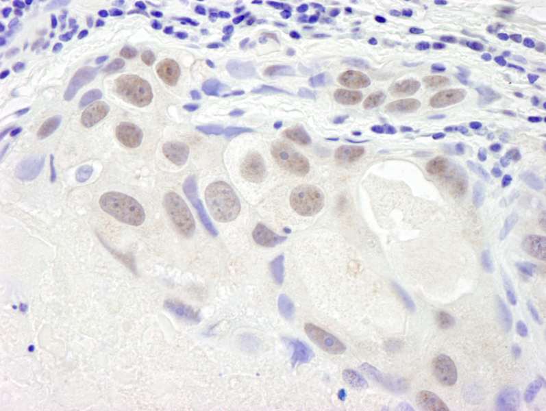 Detection of Human SMC6 by Immunohistochemistry. Sample: FFPE section of human breast tumor. Antibody: Affinity purified rabbit anti-SMC6 used at a dilution of 1:250.