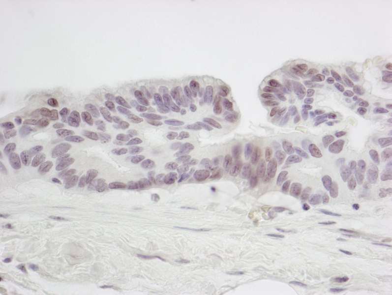 Detection of Human SMC6 by Immunohistochemistry. Sample: FFPE section of human ovarian tumor. Antibody: Affinity purified rabbit anti-SMC6 used at a dilution of 1:250.