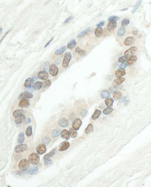 Detection of Human SMC6 by Immunohistochemistry. Sample: FFPE section of human prostate carcinoma. Antibody: Affinity purified rabbit anti-SMC6 used at a dilution of 1:1000 (1 ug/ml). Detection: DAB.