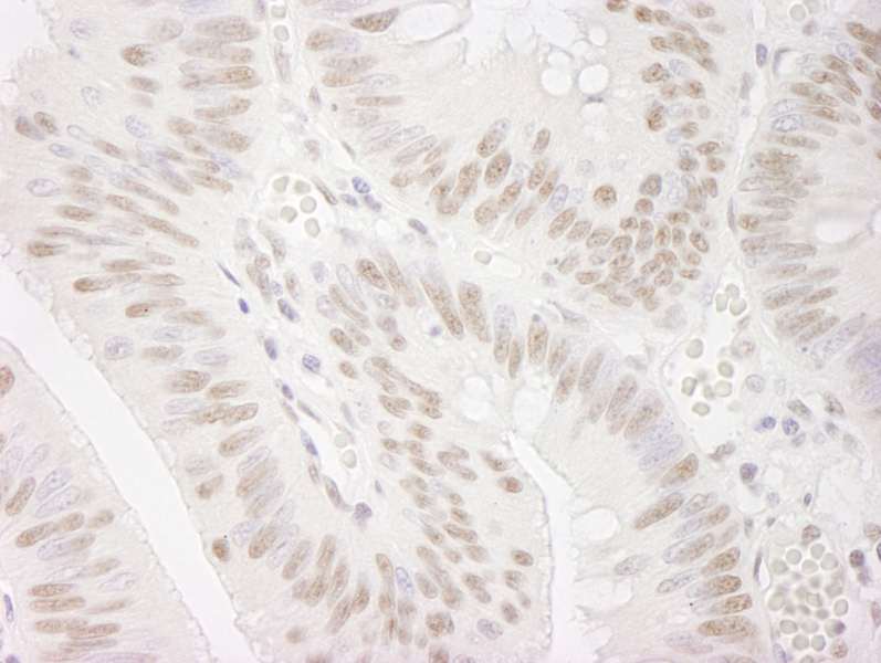Detection of Human PPP4R3 Alpha by Immunohistochemistry. Sample: FFPE section of human colon carcinoma. Antibody: Affinity purified rabbit anti-PPP4R3 Alpha used at a dilution of 1:250. Epitope Retrieval Buffer-High pH (IHC-101J) was substituted for Epitope Retrieval Buffer-Reduced pH.