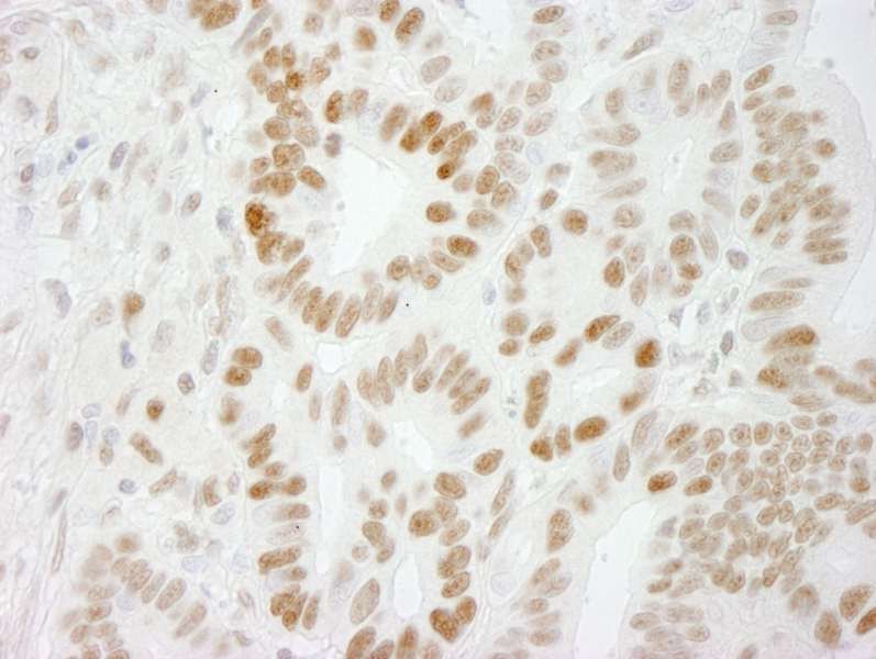 Detection of Human PPP4R3 Alpha by Immunohistochemistry. Sample: FFPE section of human stomach carcinoma. Antibody: Affinity purified rabbit anti-PPP4R3 Alpha used at a dilution of 1:250. Epitope Retrieval Buffer-High pH (IHC-101J) was substituted for Epitope Retrieval Buffer-Reduced pH.