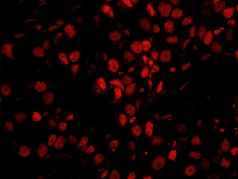 Detection of Human PPP4R3 Alpha by Immunofluorescence. Sample: FFPE section of human breast carcinoma. Antibody: Affinity purified rabbit anti-PPP4R3 Alpha used at a dilution of 1:250. Detection: Red-fluorescent goat anti-rabbit IgG highly cross-adsorbed used at a dilution of 1:100. Epitope Retrieval Buffer-High pH (IHC-101J) was substituted for Epitope Retrieval Buffer-Reduced pH.