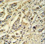 ASM3A Antibody IHC of formalin-fixed and paraffin-embedded breast carcinoma followed by peroxidase-conjugated secondary antibody and DAB staining.