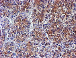IHC of paraffin-embedded Carcinoma of Human liver tissue using anti-SMS mouse monoclonal antibody.