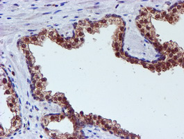 IHC of paraffin-embedded Carcinoma of Human prostate tissue using anti-SMS mouse monoclonal antibody.
