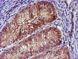 IHC of paraffin-embedded Adenocarcinoma of Human endometrium tissue using anti-SMS mouse monoclonal antibody.