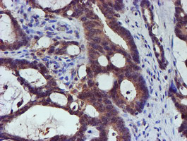 IHC of paraffin-embedded Adenocarcinoma of Human colon tissue using anti-SMS mouse monoclonal antibody.