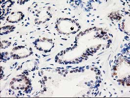 IHC of paraffin-embedded Carcinoma of Human prostate tissue using anti-SMS mouse monoclonal antibody.
