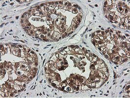 IHC of paraffin-embedded Adenocarcinoma of Human ovary tissue using anti-SMS mouse monoclonal antibody.