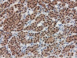 IHC of paraffin-embedded Carcinoma of Human thyroid tissue using anti-SMS mouse monoclonal antibody.