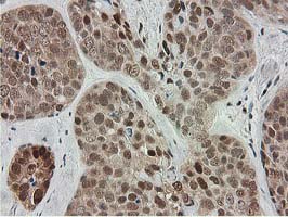 IHC of paraffin-embedded Adenocarcinoma of Human breast tissue using anti-SMS mouse monoclonal antibody.