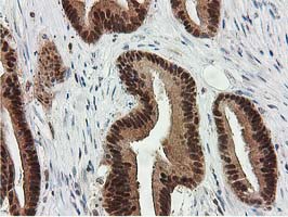 IHC of paraffin-embedded Adenocarcinoma of Human colon tissue using anti-SMS mouse monoclonal antibody.