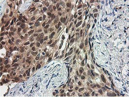 IHC of paraffin-embedded Carcinoma of Human lung tissue using anti-SMS mouse monoclonal antibody.