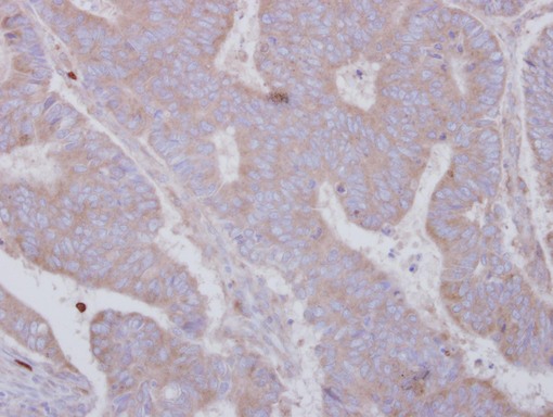 IHC of paraffin-embedded Colon ca, using SMYD3 antibody at 1:250 dilution.