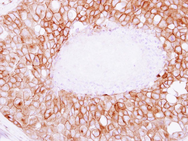 IHC of paraffin-embedded Breast ca, using SNAP23 antibody at 1:250 dilution.