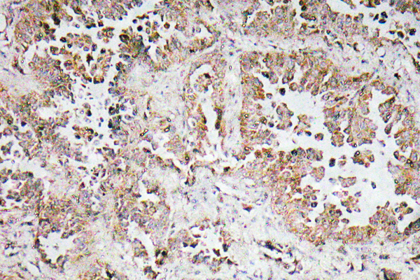 IHC of Synphilin-1 (R846) pAb in paraffin-embedded lung carcinoma. tissue.