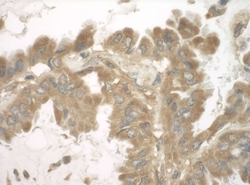 Detection of Human SND1 by Immunohistochemistry. Sample: FFPE section of human lung carcinoma. Antibody: Affinity purified rabbit anti-SND1 used at a dilution of 1:200 (1 Detection: DAB.