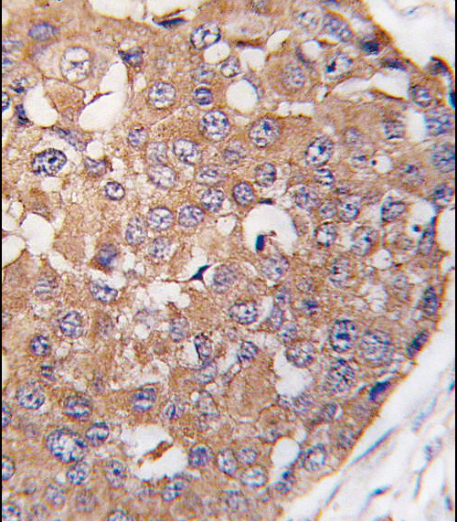 Formalin-fixed and paraffin-embedded human breast carcinoma tissue reacted with SNK Antibody (C-term ) , which was peroxidase-conjugated to the secondary antibody, followed by DAB staining. This data demonstrates the use of this antibody for immunohistochemistry; clinical relevance has not been evaluated.