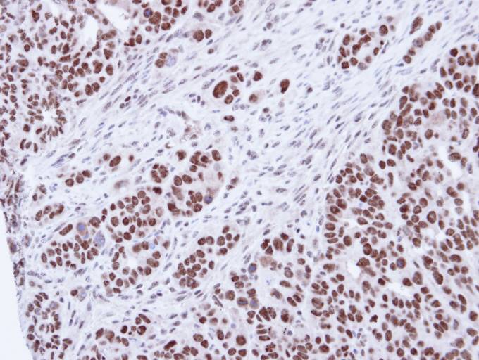 IHC of paraffin-embedded NCIN87 Xenograft using SNRK antibody at 1:100 dilution.