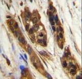 SNR27 Antibody immunohistochemistry of formalin-fixed and paraffin-embedded human bladder carcinoma followed by peroxidase-conjugated secondary antibody and DAB staining.