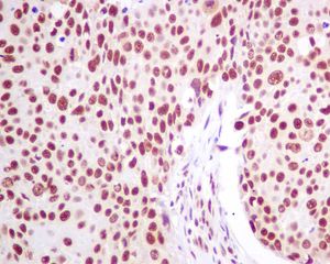 IHC of paraffin-embedded human squamous lung carcinoma tissue using anti-SNRPA1 antibody.
