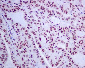 IHC of paraffin-embedded human thyroid gland carcinoma tissue using anti-SNRPA1 antibody.