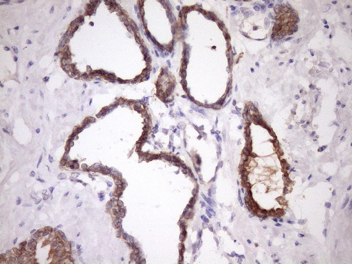 IHC of paraffin-embedded Carcinoma of Human prostate tissue using anti-SNRPB2 mouse monoclonal antibody. (Heat-induced epitope retrieval by Tris-EDTA, pH8.0)(1:150).