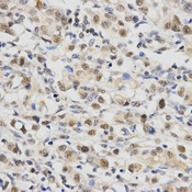 Immunohistochemistry of paraffin-embedded human stomach cancer using SNRPE antibody at dilution of 1:200 (x400 lens)