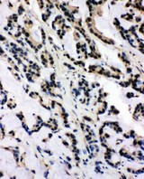 SNRPN antibody. IHC(P): Human Intestinal Cancer Tissue.