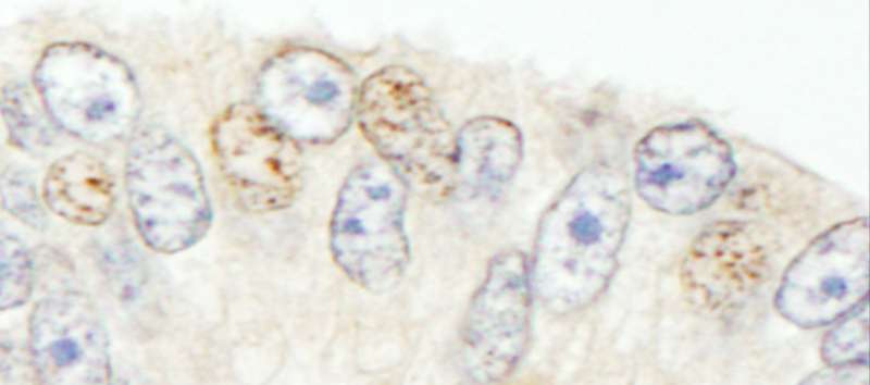 Detection of Human NCOA62 by Immunohistochemistry. Sample: FFPE section of human prostate carcinoma. Antibody: Affinity purified rabbit anti-NCOA62 used at a dilution of 1:1000 (1 ug/ml). Detection: DAB.
