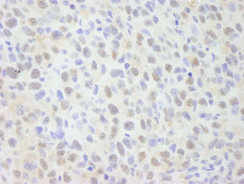 Detection of Mouse NCOA62 by Immunohistochemistry. Sample: FFPE section of mouse squamous cell carcinoma. Antibody: Affinity purified rabbit anti-NCOA62 used at a dilution of 1:250.