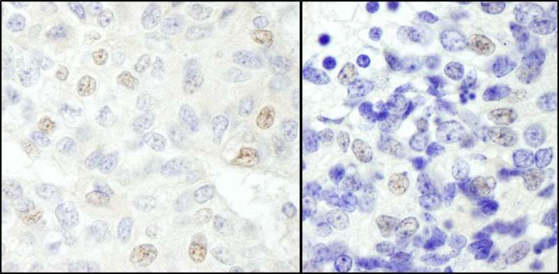 Detection of Human and Mouse NCOA62 by Immunohistochemistry. Sample: FFPE section of human breast carcinoma (left) and mouse teratoma (right). Antibody: Affinity purified rabbit anti-NCOA62 used at a dilution of 1:200 (1 ug/ml). Detection: DAB.