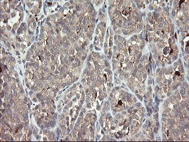 IHC of paraffin-embedded Carcinoma of Human thyroid tissue using anti-SNX8 mouse monoclonal antibody.