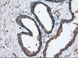 IHC of paraffin-embedded Carcinoma of Human prostate tissue using anti-SNX9 mouse monoclonal antibody. (Dilution 1:50).