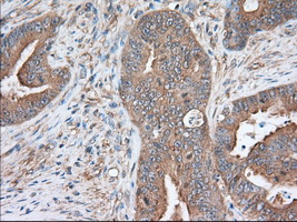 IHC of paraffin-embedded Adenocarcinoma of Human colon tissue using anti-SNX9 mouse monoclonal antibody. (Dilution 1:50).