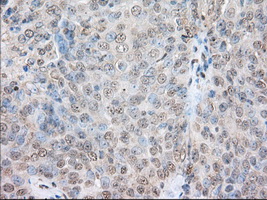 IHC of paraffin-embedded Adenocarcinoma of Human ovary tissue using anti-SNX9 mouse monoclonal antibody. (Dilution 1:50).