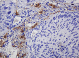 IHC of paraffin-embedded Carcinoma of Human lung tissue using anti-SOAT2 mouse monoclonal antibody. (Heat-induced epitope retrieval by 10mM citric buffer, pH6.0, 120°C for 3min).