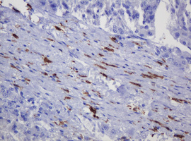 IHC of paraffin-embedded Carcinoma of Human liver tissue using anti-SOAT2 mouse monoclonal antibody. (Heat-induced epitope retrieval by 10mM citric buffer, pH6.0, 120°C for 3min).