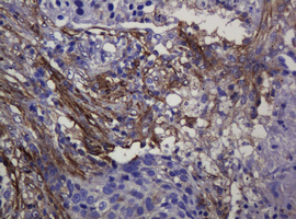 IHC of paraffin-embedded Carcinoma of Human lung tissue using anti-SOAT2 mouse monoclonal antibody.