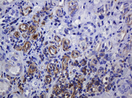 IHC of paraffin-embedded Adenocarcinoma of Human colon tissue using anti-SOAT2 mouse monoclonal antibody.