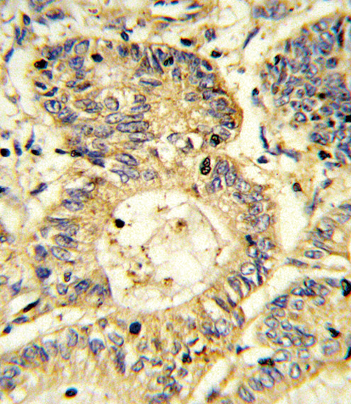 Formalin-fixed and paraffin-embedded human colon carcinoma reacted with SOCS1 Antibody , which was peroxidase-conjugated to the secondary antibody, followed by DAB staining. This data demonstrates the use of this antibody for immunohistochemistry; clinical relevance has not been evaluated.