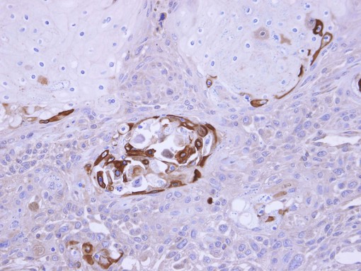 IHC of paraffin-embedded Ca922 xenograft using SOCS5 antibody at 1:100 dilution.